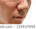 Strawberry nose close-up: pores and blackheads of a man in his 30s 120537994