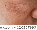 Close-up photo of cheek pores: Focus on skin concerns (man in his 30s) 120537995