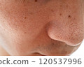 Strawberry nose close-up: pores and blackheads of a man in his 30s 120537996