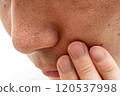 Strawberry nose close-up: pores and blackheads of a man in his 30s 120537998