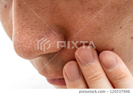 Strawberry nose close-up: pores and blackheads of a man in his 30s 120537998