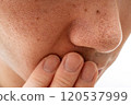 Strawberry nose close-up: pores and blackheads of a man in his 30s 120537999