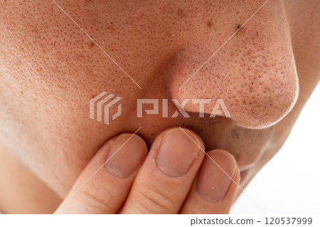 草莓鼻特寫：30多歲男性的毛孔與角蛋白塞 120537999