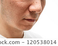 Strawberry nose close-up: pores and blackheads of a man in his 30s 120538014