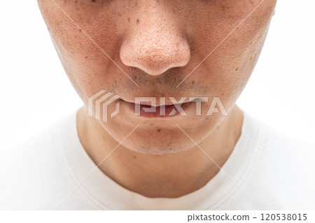 草莓鼻特寫：30多歲男性的毛孔與角蛋白塞 120538015