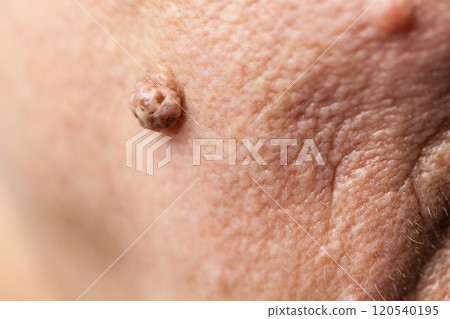 Elderly pensioner female, dermal fibroma closeup. Elderly pensioner female, dermal fibroma closeup. 120540195
