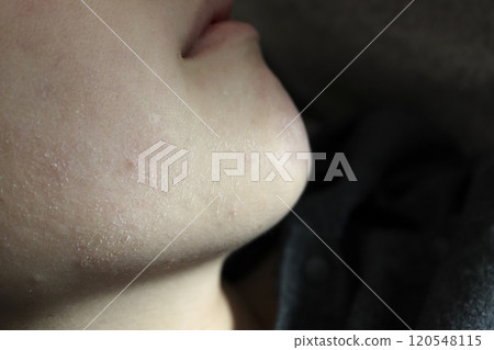 Woman has dry skin on her chin 120548115