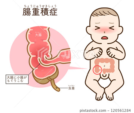 腸套疊，插圖 120561284