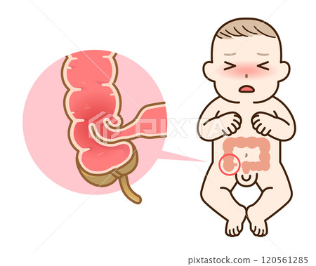 Intussusception, illustration 120561285