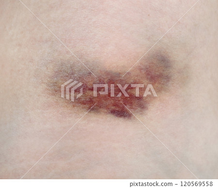 Close up purple bruise on skin. Bruise from impact. Bruising and hematoma on human body 120569558