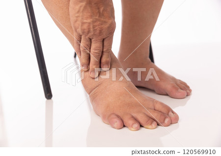 Overweight Senior Women and Ankle Swelling. Overweight Senior Women and Ankle Swelling. 120569910