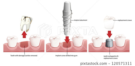 Dental Implant Procedure Illustration Dental Implant Procedure Illustration 120571311