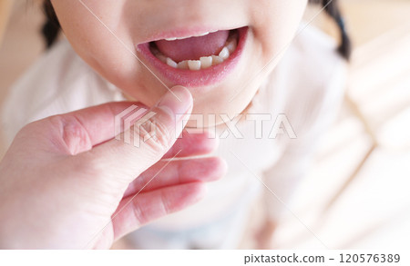 A child's mouth with misaligned teeth 120576389