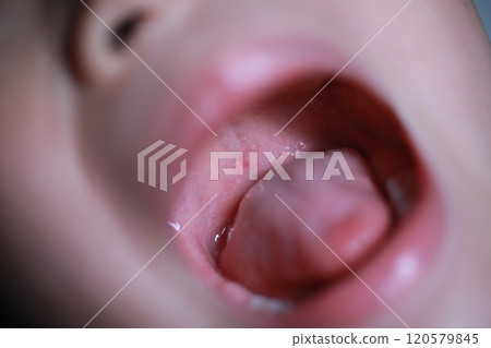 手足口病 120579845