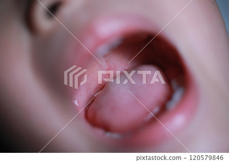 手足口病 120579846