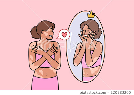 Woman with vitiligo syndrome looks in mirror and smiles, accepting herself as she is Woman with vitiligo syndrome looks in mirror and smiles, accepting herself as she is 120583200