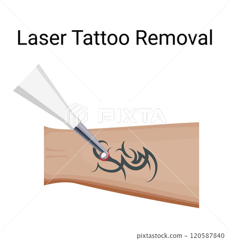Laser Tattoo Removal Procedure, vector illustration 120587840