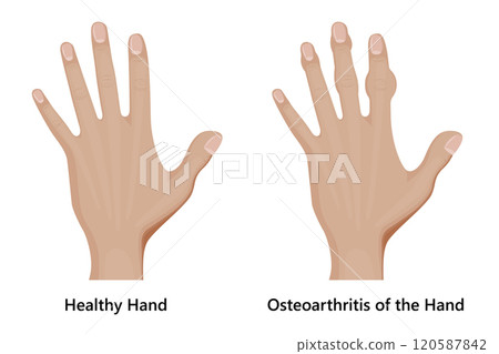 Healthy Hand and Hand with Osteoarthritis. 120587842
