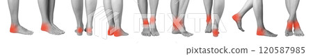 Set of female feet showing symptoms of pain and inflammation, including redness, strain, and tension Set of female feet showing symptoms of pain and inflammation, including redness, strain, and tension 120587985