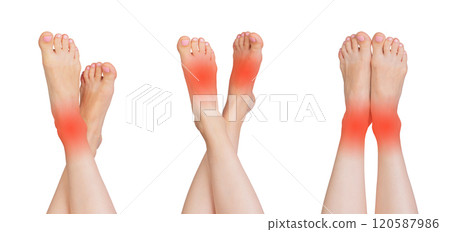 Set of female feet showing signs of pain, injury, and inflammation, including redness and swelling. 120587986