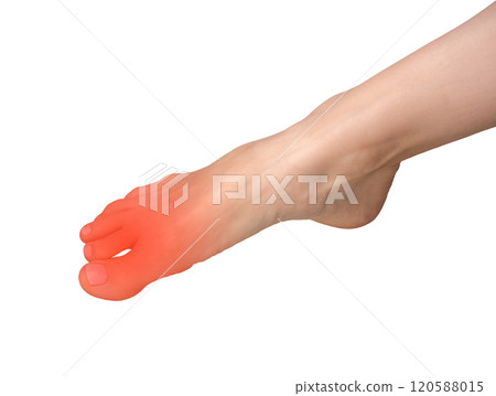 Foot pain with inflamed joint and neuropathy. Big toe ache, cramp, or strain caused by arthritis, 120588015