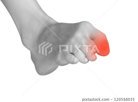 Big toe pain, joint ache, and inflammation. Sore, painful foot with neuropathy, contusion, and Big toe pain, joint ache, and inflammation. Sore, painful foot with neuropathy, contusion, and 120588035