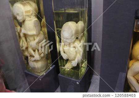 Museum exhibit of human pathology Museum exhibit of human pathology 120588403