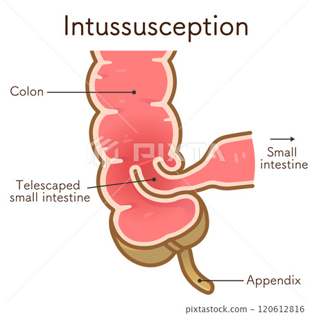 Intussusception, illustration Intussusception, illustration 120612816
