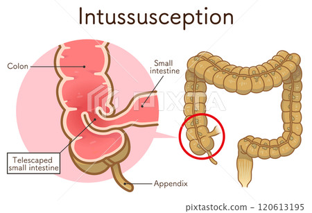 腸套疊，插圖 120613195