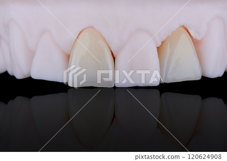 High-quality naturally dental single crowns made of zirconium for fixation to the frontal teeth of upper jaw. 120624908