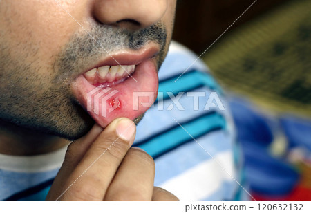 Asian man have aphthous ulcers on mouth 120632132