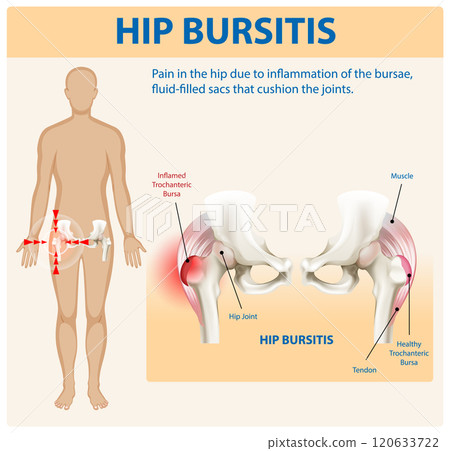 Understanding Hip Bursitis and Its Effects 120633722
