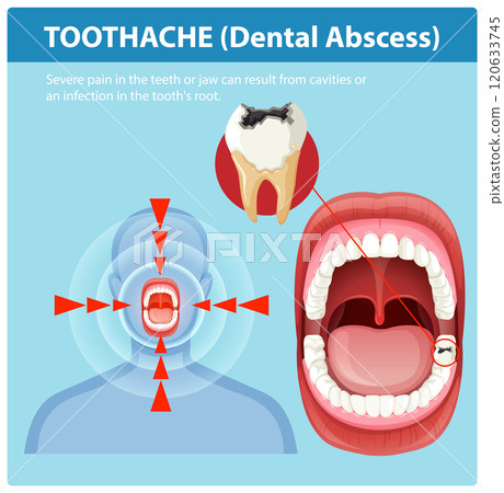 Understanding Toothache and Dental Abscess Understanding Toothache and Dental Abscess 120633745