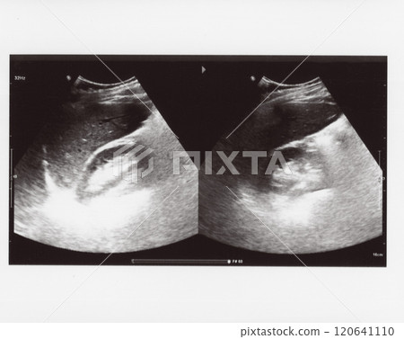 full abdomen ultrasound sonogram 120641110