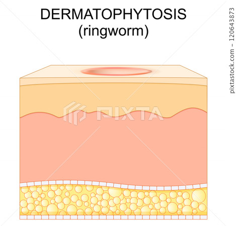 Dermatophytosis. human skin with Ringworm. Dermatophytosis. human skin with Ringworm. 120643873