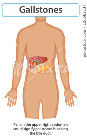 Understanding Gallstones and Their Symptoms 120662137