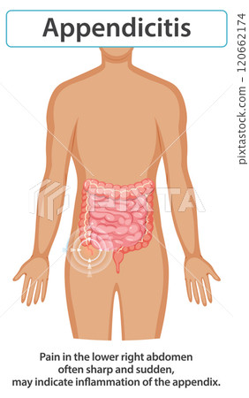 Appendicitis Symptoms and Diagnosis Illustration 120662174