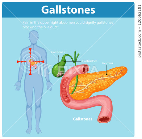 Understanding Gallstones and Their Effects 120662181