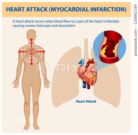 Understanding Heart Attack and Its Effects 120662184