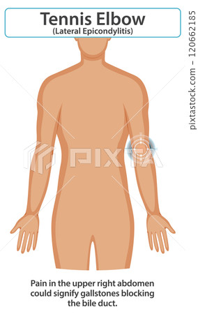 Tennis Elbow Medical Illustration 120662185