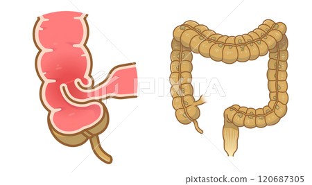 腸套疊，插圖 120687305