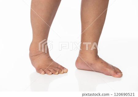 Overweight Senior Women and Ankle Swelling. 120690521