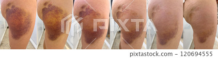 Stages of Bruise Healing on Human Skin Over Time 120694555