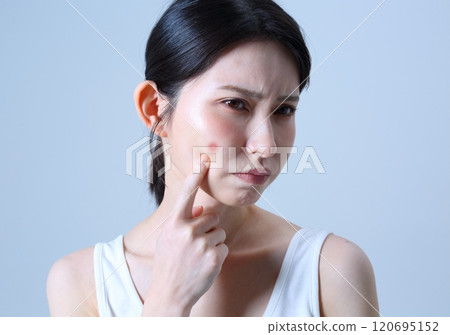 Image of a woman suffering from acne 120695152