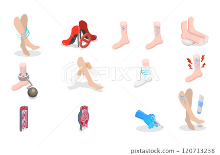 3D Isometric Flat Set of Varicose Treatment, Health Care 3D Isometric Flat Set of Varicose Treatment, Health Care 120713238