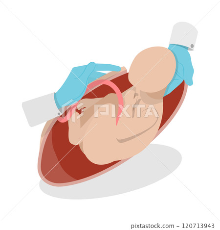 3D Isometric Flat Illustration of Cesarean Section, Medical Surgery and Abdominal Incision 3D Isometric Flat Illustration of Cesarean Section, Medical Surgery and Abdominal Incision 120713943