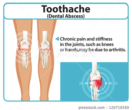 Knee Joint Pain and Arthritis Illustration Knee Joint Pain and Arthritis Illustration 120718589
