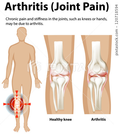 Understanding Arthritis and Joint Pain 120718594