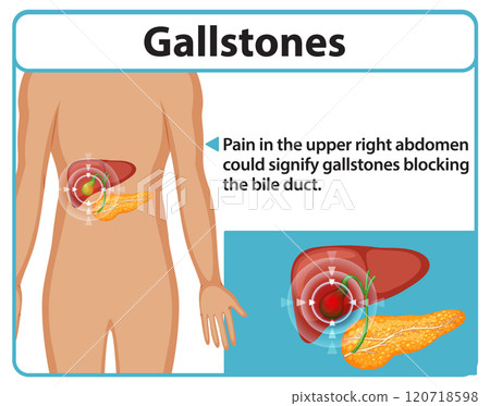 Understanding Gallstones and Symptoms 120718598