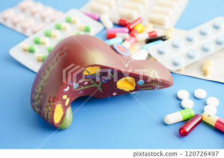 Liver model with pill drug treatment, Cirrhosis, Liver cancer, fatty liver. 120726497